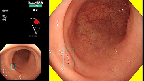 EndoBRAIN®-EYEによる病変検出支援の様子