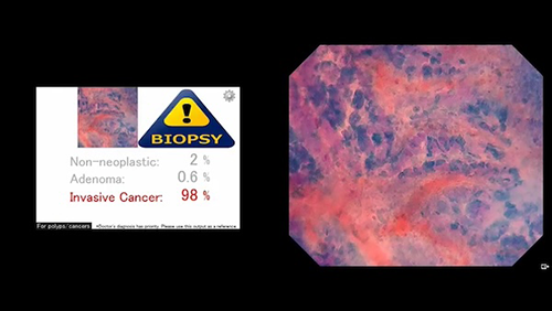 EndoBRAIN®-Plusでは癌の鑑別診断支援を行う